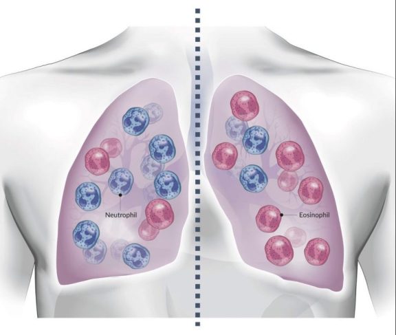 Neutrophil and eosinophil in lungs illustration