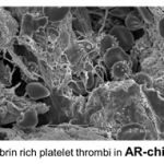 Flow clot illustration with fibrin rich platelet thrombi in AR-Chip text below it