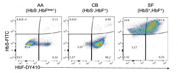 Red blood cells costained with anti-HbS and HbF for sickle cell gene therapy research