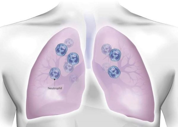 sputum samples neutrophil-driven immune responses in the lung